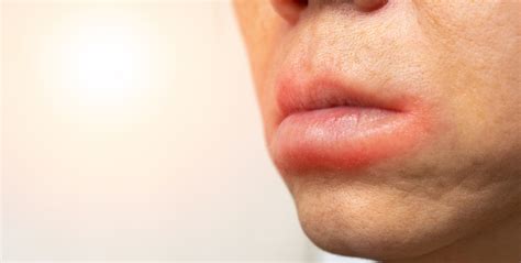 Case Report: Bradykinin- vs Histamine-Mediated Angioedema
