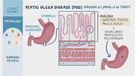 Peptic Ulcer