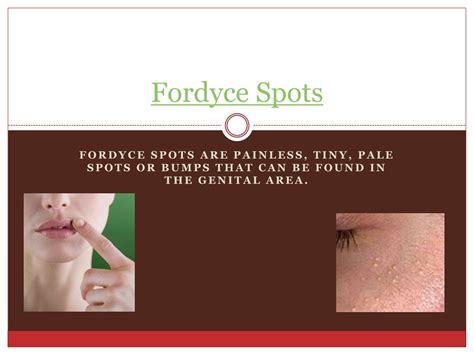 PPT - Fordyce Spots Treatment PowerPoint Presentation, free download - ID:1494291