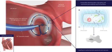 Pulsed Field Ablation for the Treatment of Atrial Fibrillation: PULSED ...