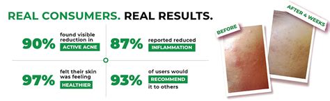 The Pink Foundry Acne Moisturiser I Treats & Prevents Breakout, Soothes ...