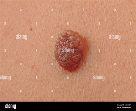 Benign nevus skin dermatology hi-res stock photography and images - Alamy