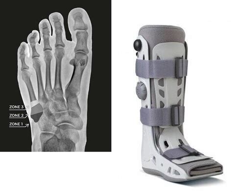 Base of 5th Metatarsal Fracture Treatment Melbourne | Big Toe Fusion