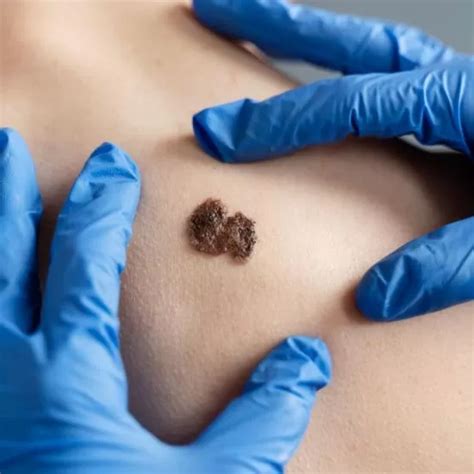Dermato Surgery in Jaipur: Expert Solutions for Skin Conditions ...