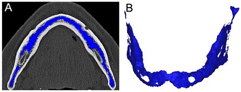 Retrospective Analysis of Dental Implant Stability in Relation to ...