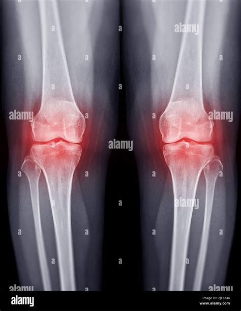 What Is The Meaning Of Knee Joint Effusion at Dolores Bennett blog