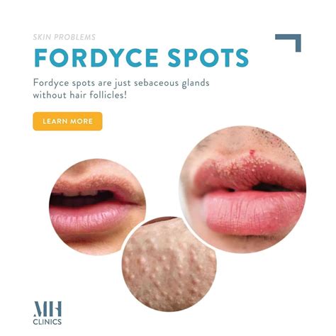 Fordyce Or Herpes