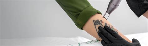 Tattoo Removal at Skin Secrets Kochi