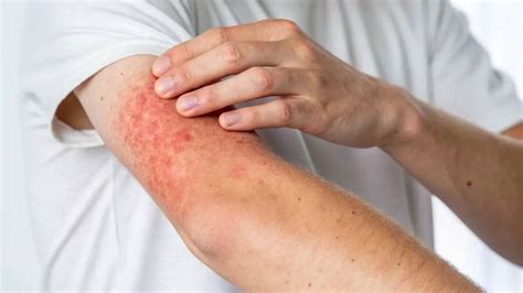 What is cold urticaria? Doctors warn of painful allergy caused by cold ...