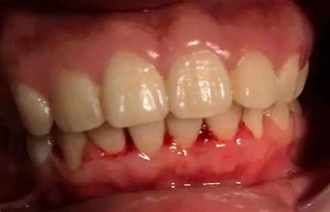 口腔科临床常见病症之—牙龈出血 - 知乎