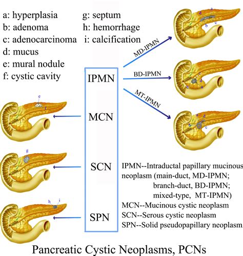 Frontiers | Cystic Neoplasms of the Pancreas: Differential Diagnosis ...