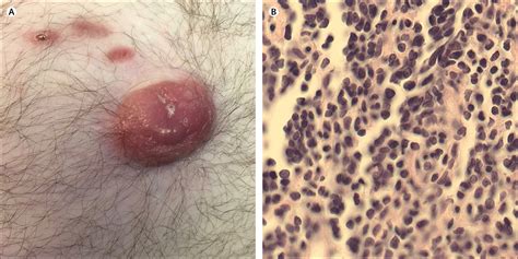 Sister Mary Joseph nodule in mantle cell lymphoma - The Lancet Oncology