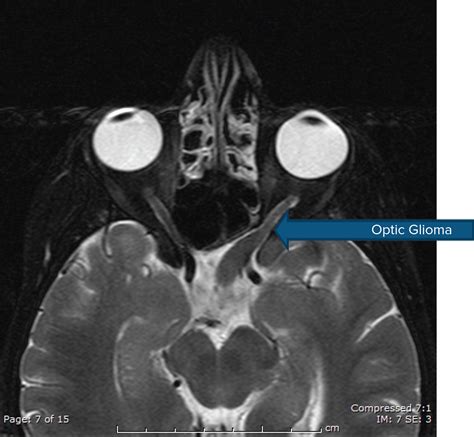 Epilepsy Due to Neurofibromatosis Type 1 | Epilepsy Foundation
