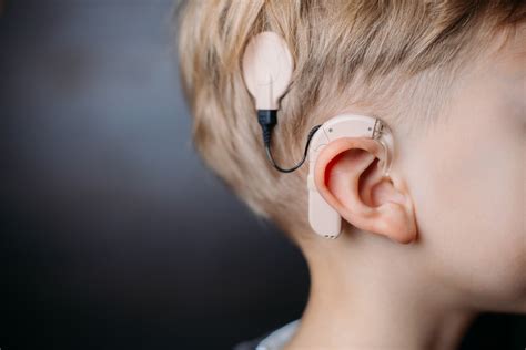 29 Facts About Cochlear Implant - Facts.net
