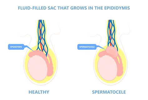 Epididymal Cyst Scrotal Masses Information | Mount Sinai New York
