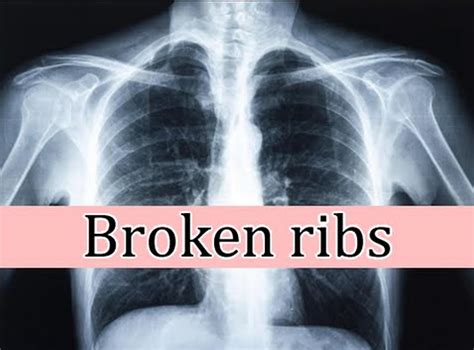 Broken Rib - Causes, Signs, Symptoms, Recovery Time & Treatment
