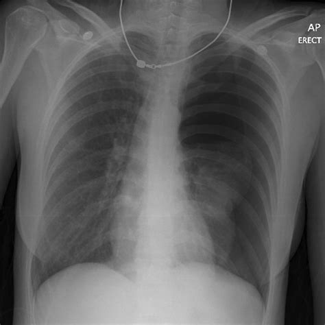 Tension Pneumothorax X Ray Chest X Ray Interpretation | A Structured