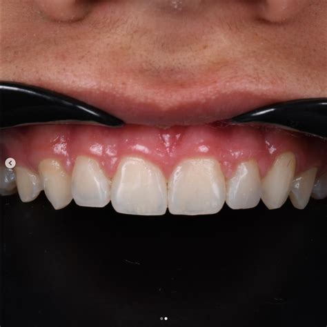 Why Composite Resin Veneers (video) | Spath Dentistry