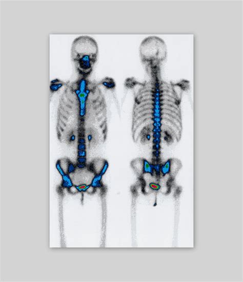 Enfermedad de Paget – CDI Marbella