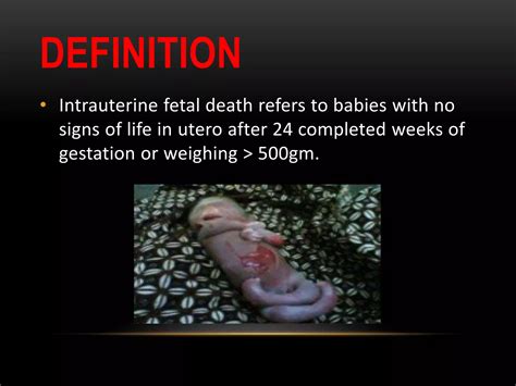 Intrauterine Fetal Demise Means