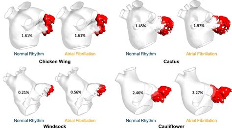 Right Atrium Anatomy