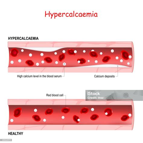 High Calcium In Blood