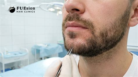 Facial Hair Transplant New Jersey: Redefining Beard & Facial Hair ...