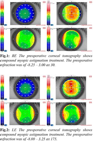 Laser Refractive Surgery in a Patient with Chorioretinal Coloboma ...