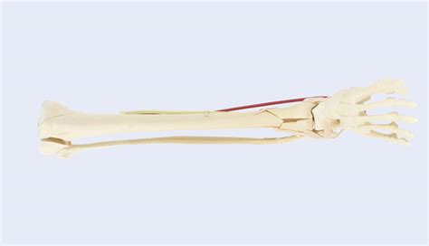 Lower Leg right w/ pilon comminuted fracture a/ prox tibial fx ...