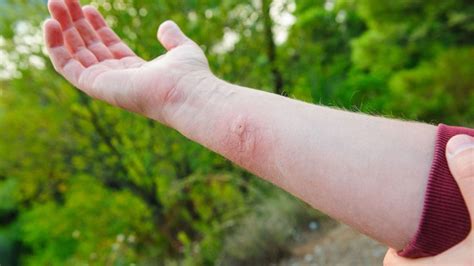 Insect Bites Matter When You Have Rheumatoid Arthritis | Everyday Health