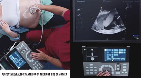 Ultrasound Training for Obstetric Outreach - Portable Ultrasound Machines