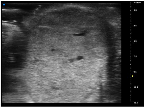 Reliability of Ultrasonographic Assessment of Depth of Invasion and Tumor Thickness in Intraoral ...