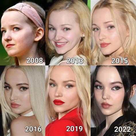 Dove Cameron Plastic Surgery Transformation Over the Years