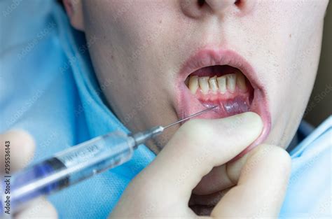 Infiltration Anesthesia 的图像结果