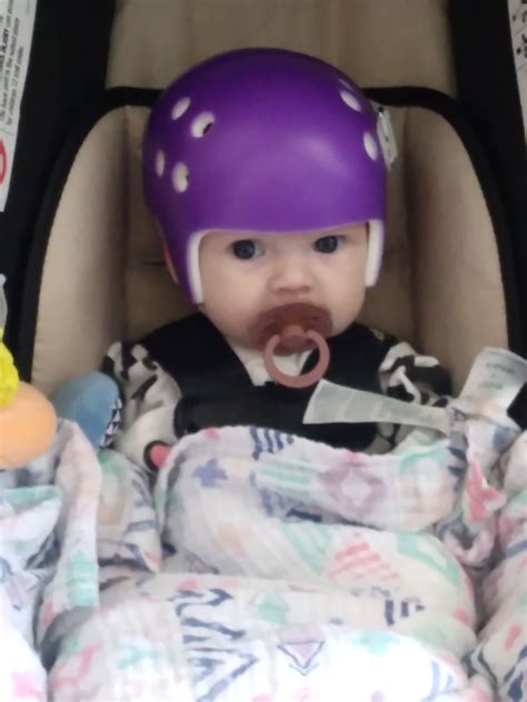 Sagittal Craniosynostosis in infant | BabyCenter