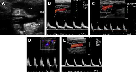 Carotid Ultrasound - Radiologic Clinics