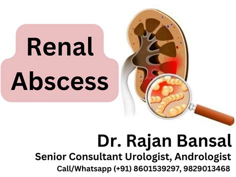 Renal Abscess: Causes, Symptoms, Diagnosis, and Treatment