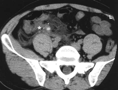 Comparison of CT and Sonography in the Diagnosis of Acute Appendicitis: A Blinded Prospective ...