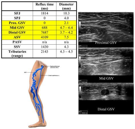 The anterior saphenous vein. Part 4. Clinical and technical ...