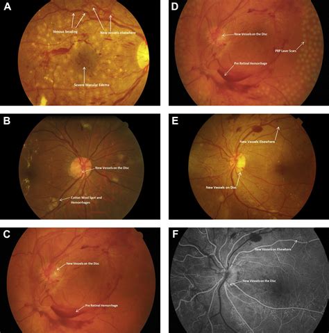 Guidelines on Diabetic Eye Care - Ophthalmology