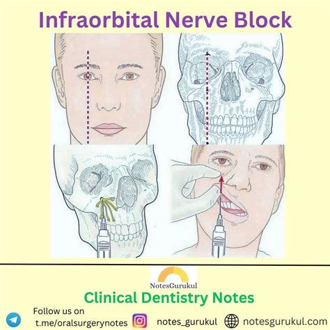 Craniofacial Surgery & Facial Plastic Surgery Short Notes on LinkedIn ...