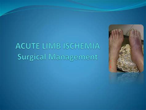 LIMB ISCHEMIA-ACUTE.pptx