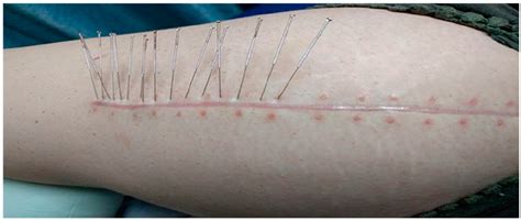 Dry Needling and Acupuncture for Scars—A Systematic Review
