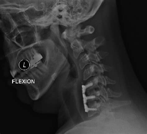 Anterior Cervical Discectomy and Fusion: A Surgical Intervention for Treating Cervical Disc ...