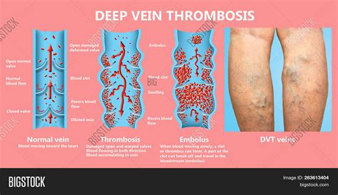 Deep Vein Thrombosis Image & Photo (Free Trial) | Bigstock