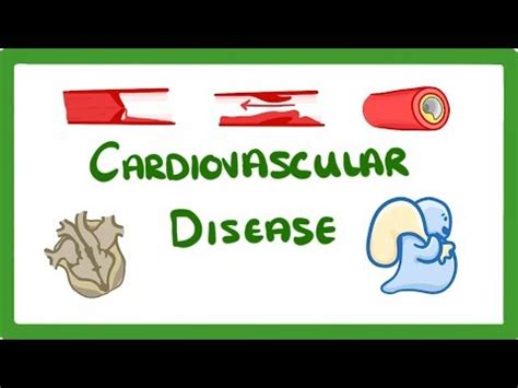 Coronary Heart Disease Video Lecture - Biology for GCSE/IGCSE - Class 10