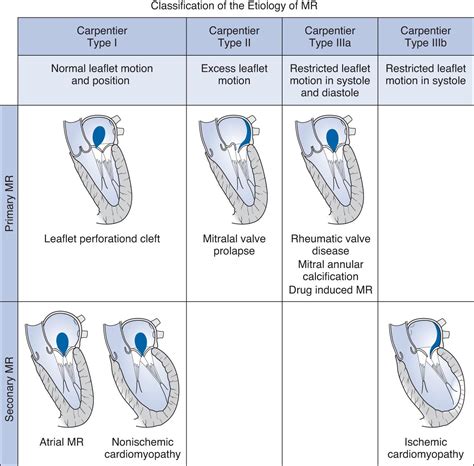 Mitral regurgitation - Clinical Tree