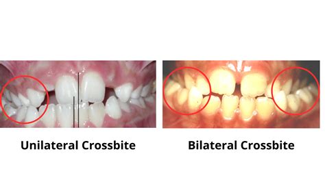 Crossbite: Understanding and Treating This Common Issue