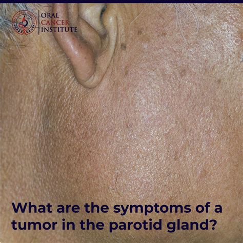 Parotid gland symptoms: What is parotid cancer? | Oral Cancer Institute posted on the topic ...