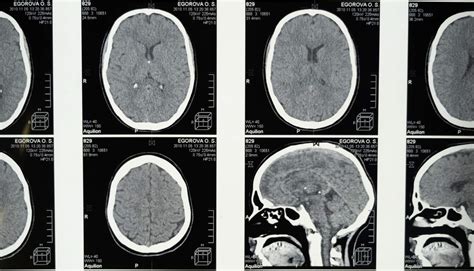 Benign Meningioma Life Expectancy